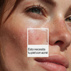 Skincare coreano para acne que sí funciona