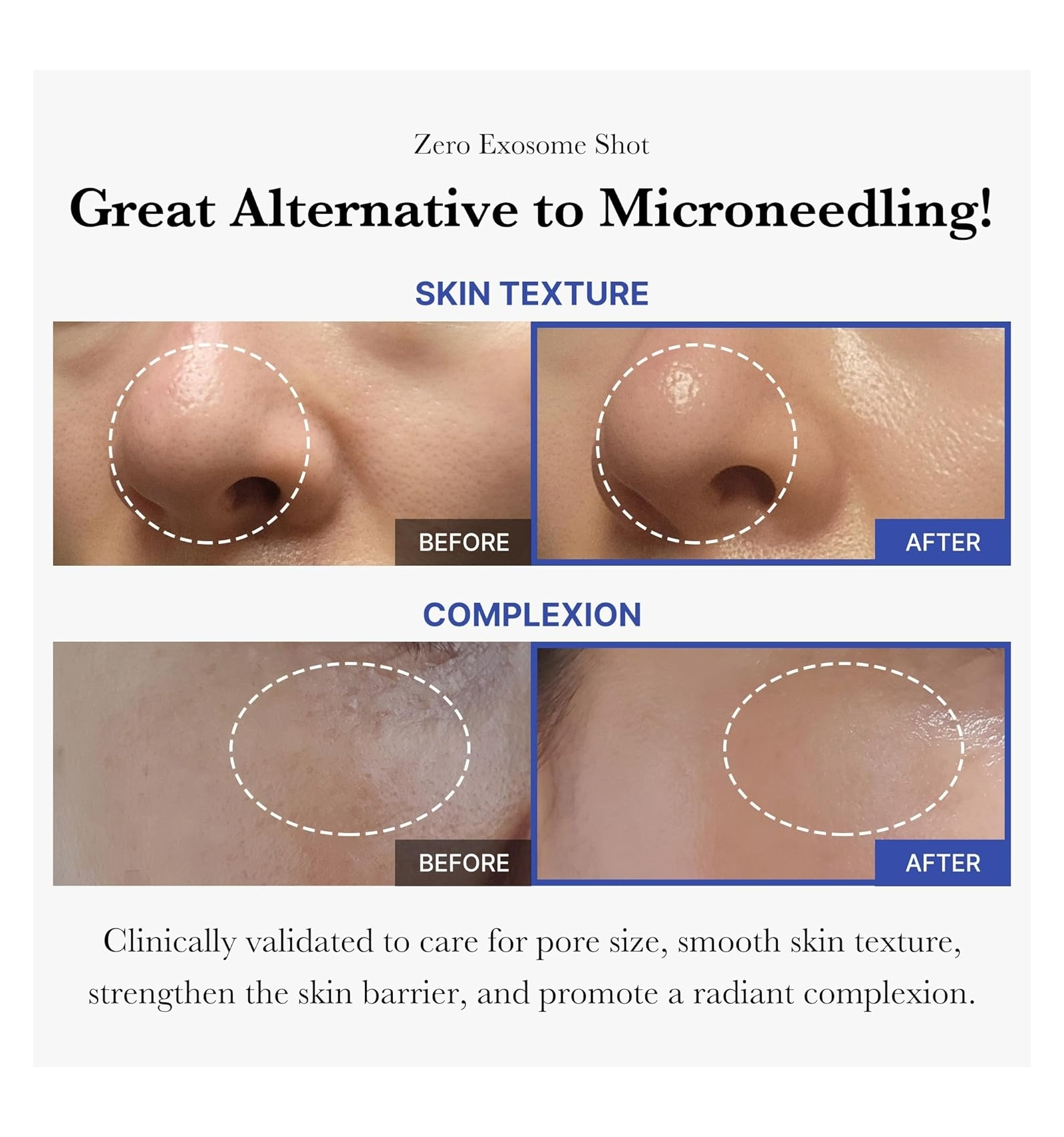 MEDICUBE - Azelaic Acid Exosome Shot 7500 30 ML | Suero Microagujas Calmante 5